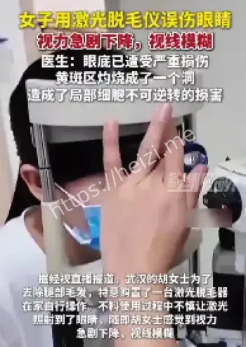 激光脱毛仪误伤