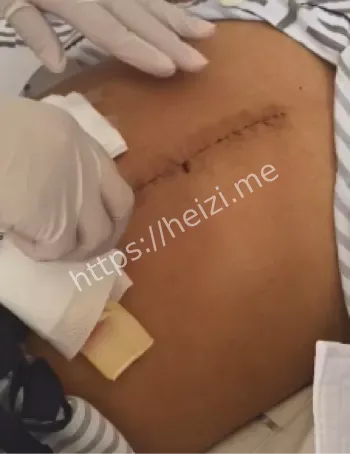 00后父亲割肝救女